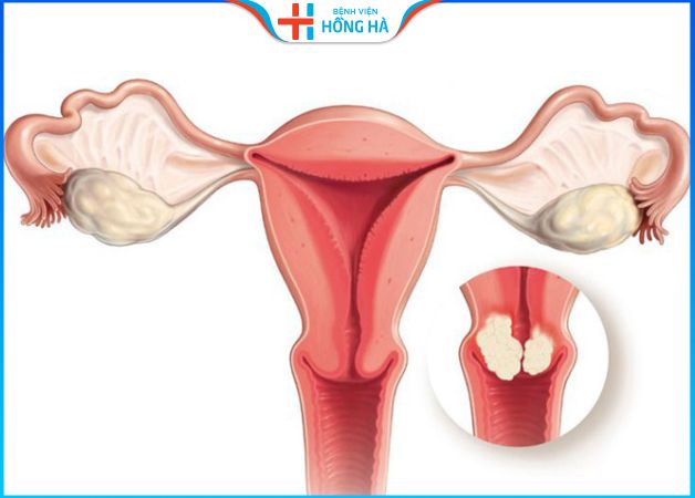 U xơ tử cung là bệnh phụ khoa phổ biến ở nữ
