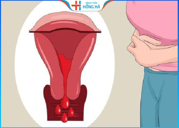 U xơ tử cung gây chảy máu âm đạo
