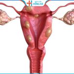Tình trạng buồng trứng đa nang 2 bên: Nguyên nhân, triệu chứng và điều trị