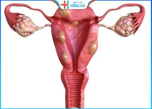 Tình trạng buồng trứng đa nang 2 bên: Nguyên nhân, triệu chứng và điều trị