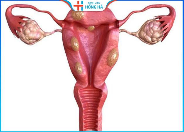 Tình trạng buồng trứng đa nang 2 bên: Nguyên nhân, triệu chứng và điều trị