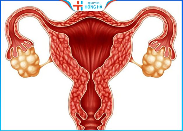 Buồng trứng đa nang 2 bên là bệnh lý phụ khoa phổ biến ở phụ nữ