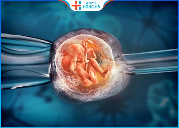Điều trị buồng trứng đa nang ở 2 bên bằng phương pháp thụ tinh ống nghiệm IVF