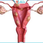 Khả năng rụng trứng của buồng trứng đa nang: Các yếu tố ảnh hưởng