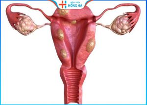 Khả năng rụng trứng của buồng trứng đa nang: Các yếu tố ảnh hưởng