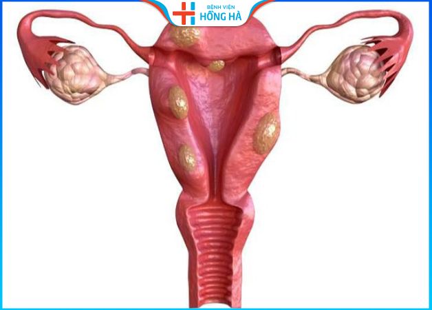 Khả năng rụng trứng của buồng trứng đa nang: Các yếu tố ảnh hưởng
