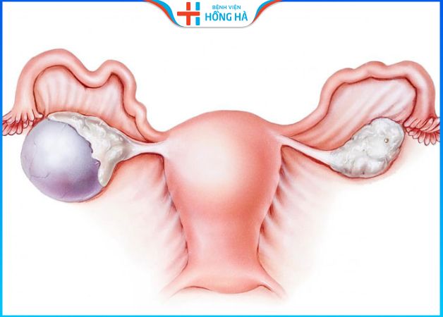 Cắt 1  bên buồng trứng được chỉ định cho người bị u nang buồng trứng