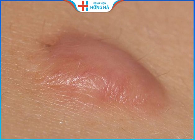 Cắt bỏ sẹo hết bao nhiêu tiền phụ thuộc vào tình trạng sẹo