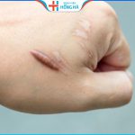Cắt bỏ sẹo hết bao nhiêu tiền – 4 yếu tố ảnh hưởng đến giá