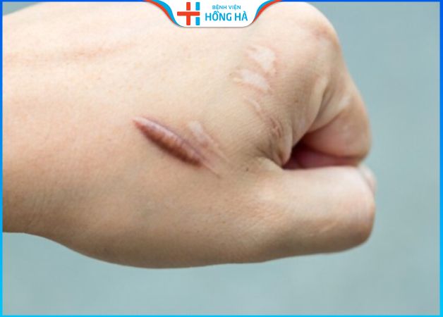 Cắt bỏ sẹo hết bao nhiêu tiền – 4 yếu tố ảnh hưởng đến giá