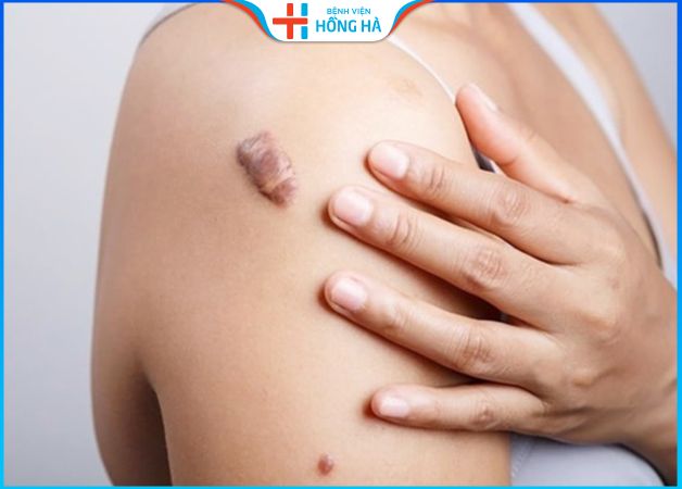 Kỹ thuật vi phẫu cắt bỏ sẹo lồi ở chân, tay