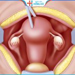 Cắt tử cung có mang thai được không? – Chuyên gia giải đáp