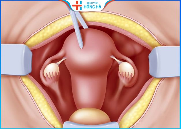 Cắt tử cung có mang thai được không? – Chuyên gia giải đáp