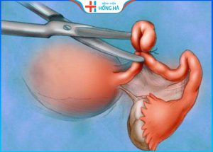 Quá trình phục hồi sau phẫu thuật cắt tử cung toàn phần