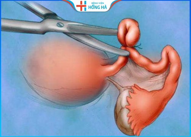 Quá trình phục hồi sau phẫu thuật cắt tử cung toàn phần