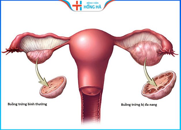 Hội chứng đa nang buồng trứng nên được điều trị kịp thời
