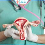 Tác động của đa nang buồng trứng một bên đến khả năng thụ thai