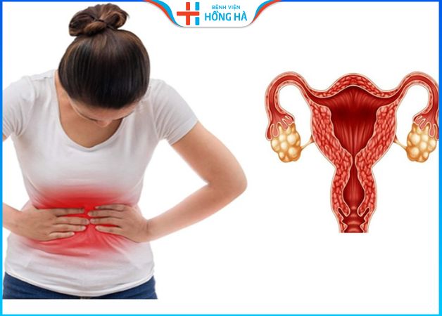 5 phương pháp điều trị bệnh đa nang buồng trứng hiệu quả