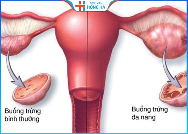 Buồng trứng đa nang là bệnh phụ khoa xảy ra ở những phụ nữ dư thừa hormone sinh dục nam
