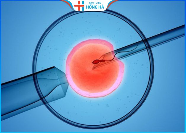 Đa nang buồng trứng có thể điều trị bằng phương pháp thụ tinh ống  nghiệm IVF