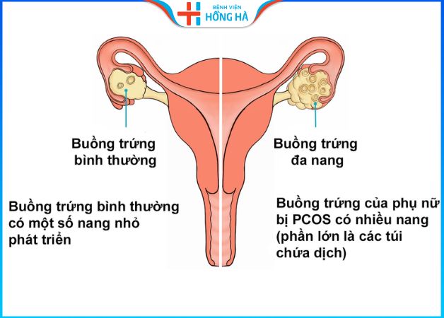 Đa nang buồng trứng là hội chứng rối loạn nội tiết tố ở nữ