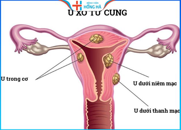 U xơ tử cung là bệnh phụ khoa phổ biến ở chị em phụ nữ