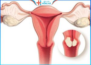 Giảm 80% đau và triệu chứng u xơ tử cung bằng cách không cần phẫu thuật