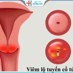 Giá điều trị viêm lộ tuyến cổ tử cung chi tiết tại Bệnh viện Hồng Hà