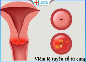 Giá điều trị viêm lộ tuyến cổ tử cung chi tiết tại Bệnh viện Hồng Hà