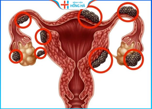 Lạc nội mạc tử cung là tình trạng các mô niêm mạc phát triển ở bên ngoài tử cung