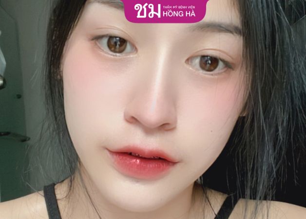 Bấm mí Thai Eyelid – Giải pháp kiến tạo mắt 2 mí long lanh, tự nhiên