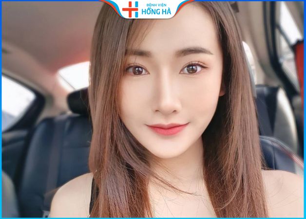 Nâng mũi cấu trúc bao lâu thì đẹp – Bác sĩ thẩm mỹ giải đáp