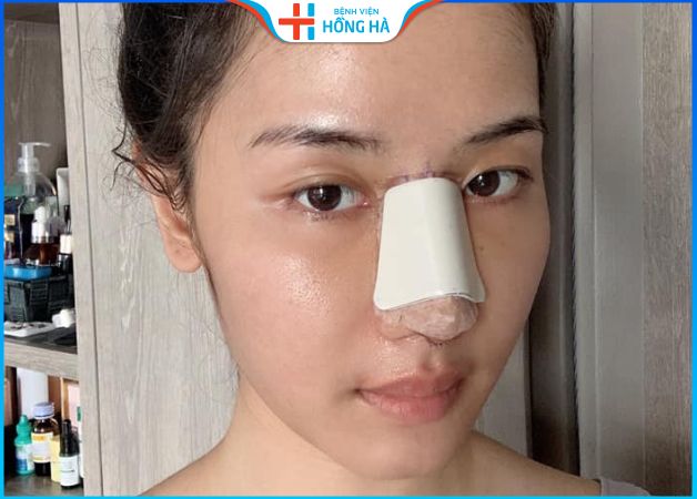 Nâng mũi cấu trúc có bị lệch không – Nguyên nhân khiến mũi lệch