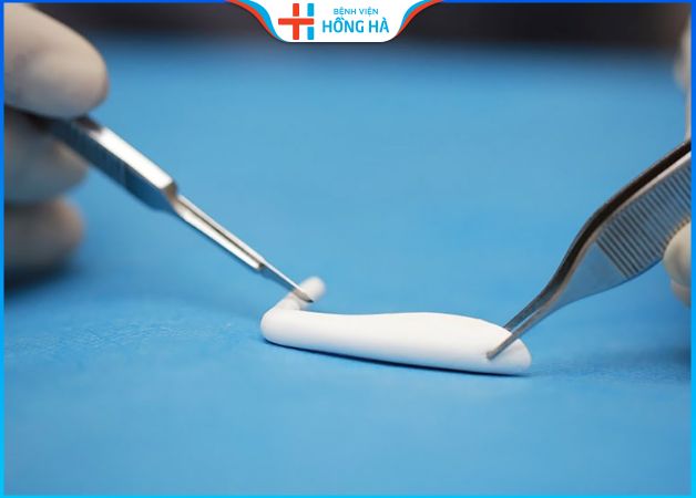 Nâng mũi Nanoform giá bao nhiêu – Kinh nghiệm thẩm mỹ nâng mũi