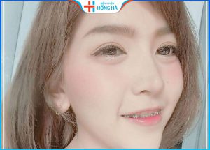Nâng mũi rồi có niềng răng được không – Lưu ý đặc biệt