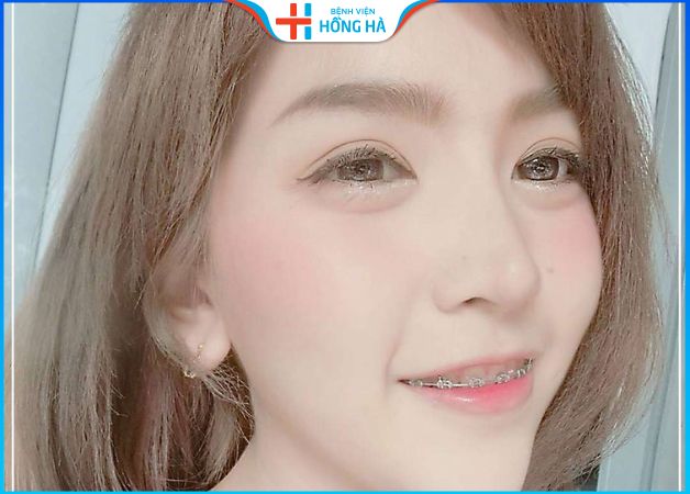 Nâng mũi rồi có niềng răng được không – Lưu ý đặc biệt