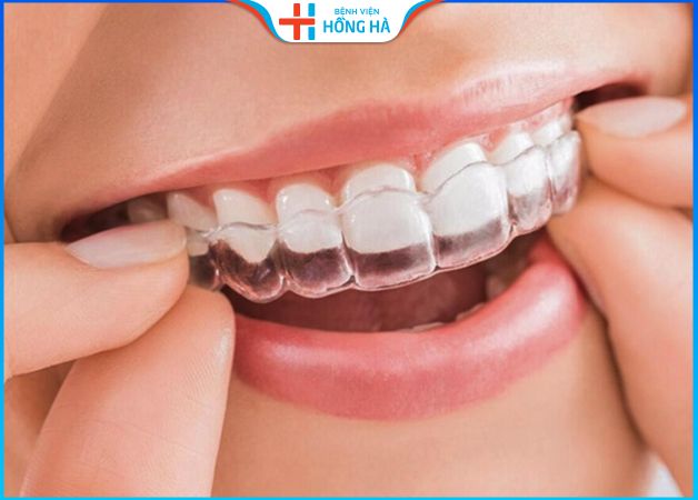 Niềng răng Invisalign sử dụng khay trong suốt có tính thẩm mỹ và hiệu quả cao
