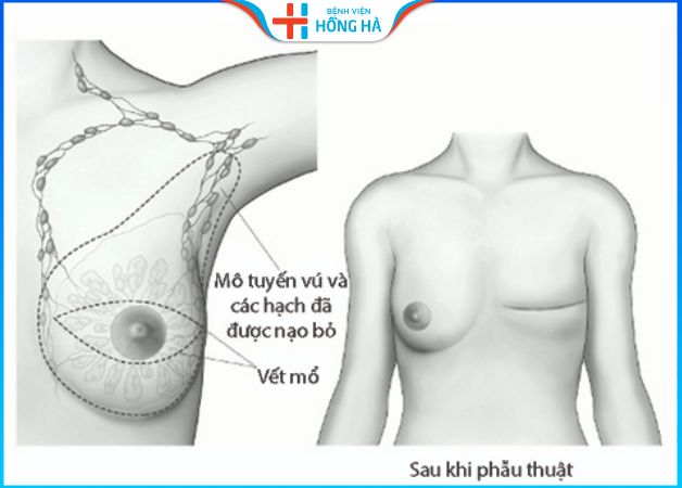 Phẫu thuật cắt bỏ tuyến vú cải biên – Điều trị ung thư vú hiệu quả