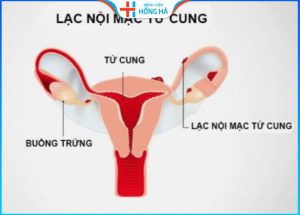 Siêu âm nội mạc tử cung: Giúp phát hiện 80% trường hợp ung thư cổ tử cung