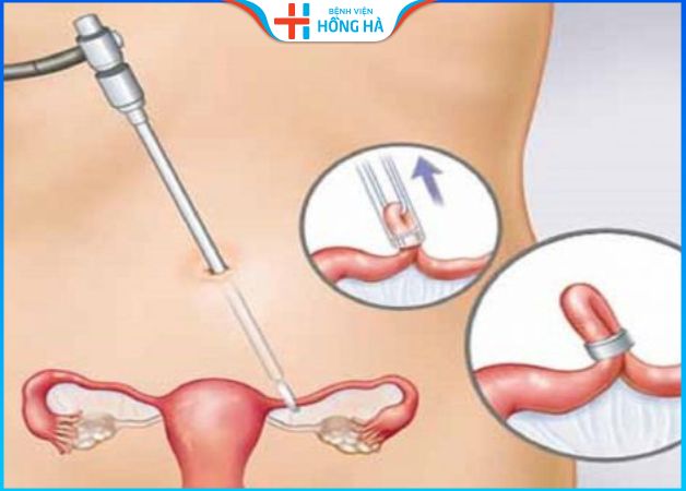 Chẩn đoán tắc ống dẫn trứng phía bên phải thông qua phẫu thuật nội soi
