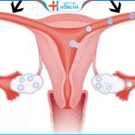 Tắc ống dẫn bên phải: Nguyên nhân, triệu chứng, điều trị thành công 70%