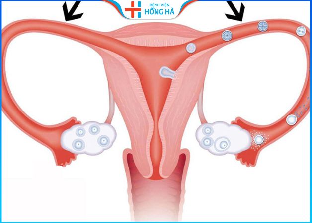 Tắc ống dẫn bên phải: Nguyên nhân, triệu chứng, điều trị thành công 70%