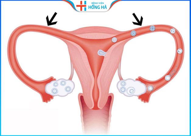 Tắc vòi trứng ảnh hưởng đến quá trình rụng trứng – Cách phòng tránh