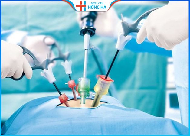 U xơ tử cung: Có cần phẫu thuật để điều trị – 2 phương pháp loại khối u xơ