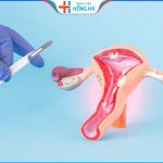 Thời gian phục hồi và ảnh hưởng sau khi phẫu thuật cắt bỏ tử cung