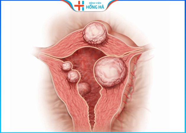 U xơ tử cung: Kích thước cần thiết để phẫu thuật