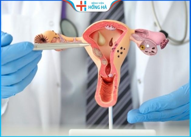 Mổ u xơ tử cung là loại bỏ các khối u ra khỏi tử cung