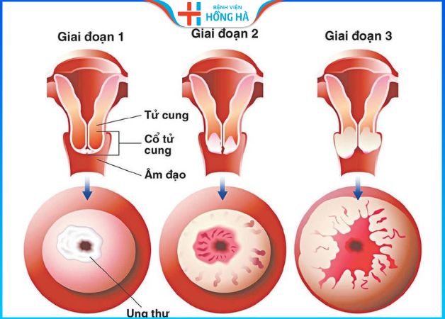 Viêm lộ tuyến cổ tử cung là tế bào tuyến phát triển ra ngoài