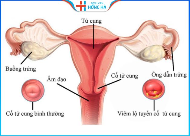 Viêm lộ tuyến cổ tử cung là tế bào tuyến phát triển ra ngoài tử cung