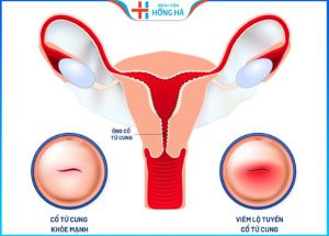 Viêm lộ tuyến cổ tử cung độ 2: Nguyên nhân và giải pháp trị an toàn hiệu quả